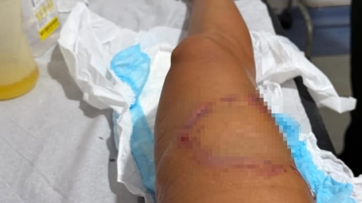 Encontro de Risco em Noronha: Advogada Mordida por Tubarão Tranquiliza Seguidores: "O bicho deve estar sem dente"